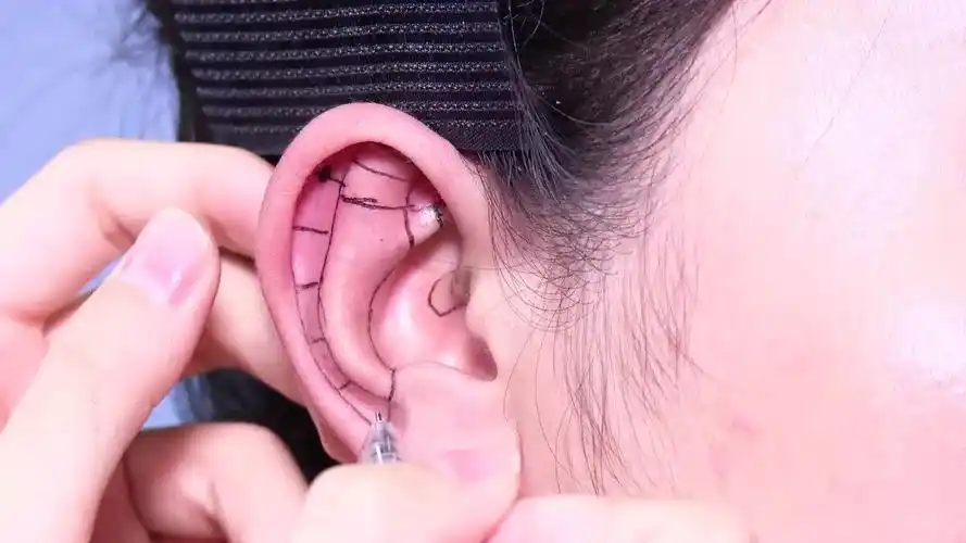 耳郭解剖部位——对耳轮