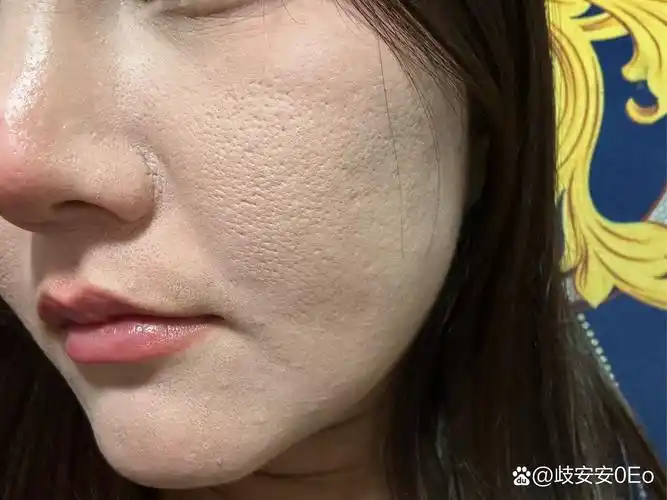 毛孔粗大怎么改善!真的好烦恼