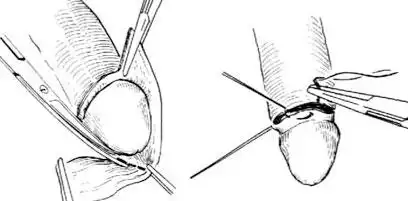 包皮环切手术过程