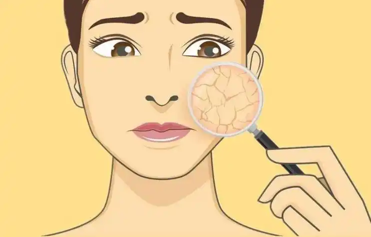 春季皮肤干燥缺水怎么办