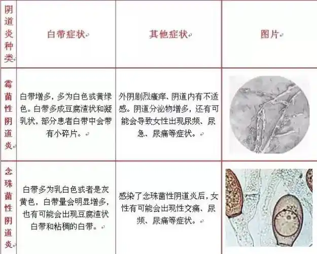 何为霉菌性阴道炎?如何预防?女性必知妇科常识①