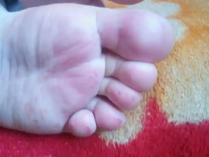 脚掌红肿痛是怎么了