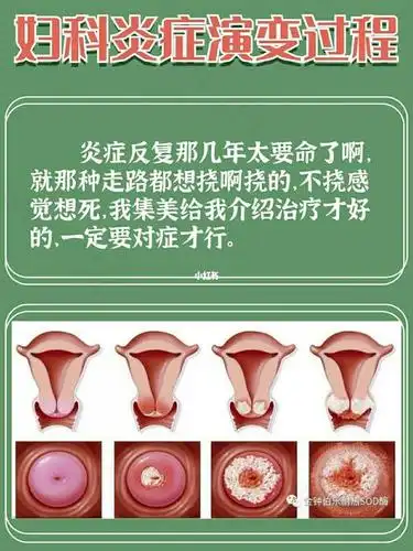 怎么判断有没有妇科炎症