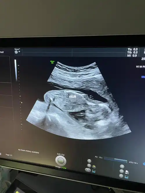 图片还没什么感觉,b超室里看到动态的样子,老母亲真的很激动!