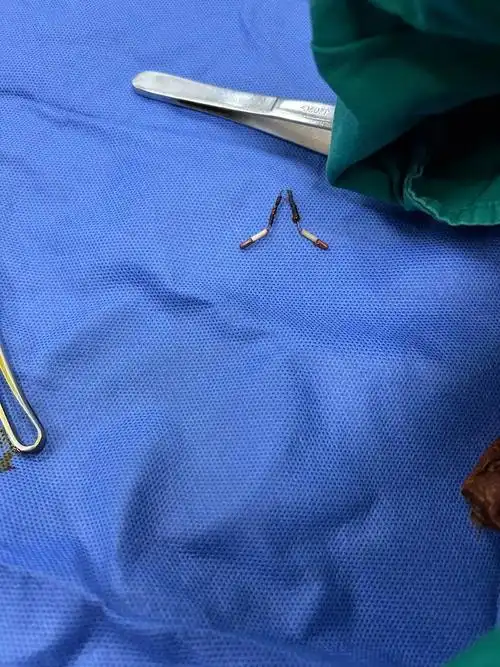 割包手术后掉环全记录!这过程太刺激了!