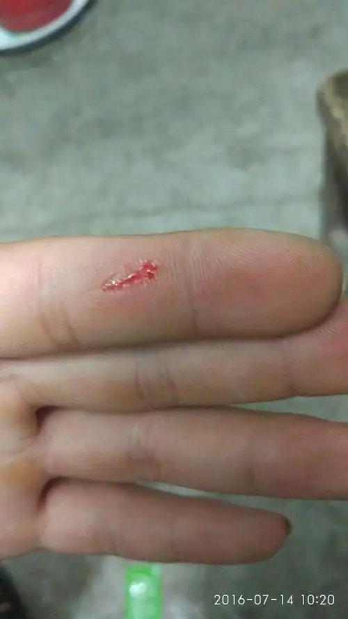 这种伤口需要打破伤风吗 1毫米深 螺丝刀挂伤 有拧生锈螺丝 白酒消毒