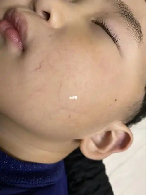 宝宝从一出生就两边脸颊都是红血丝,鼻梁一条青静,都说长大点就没有了