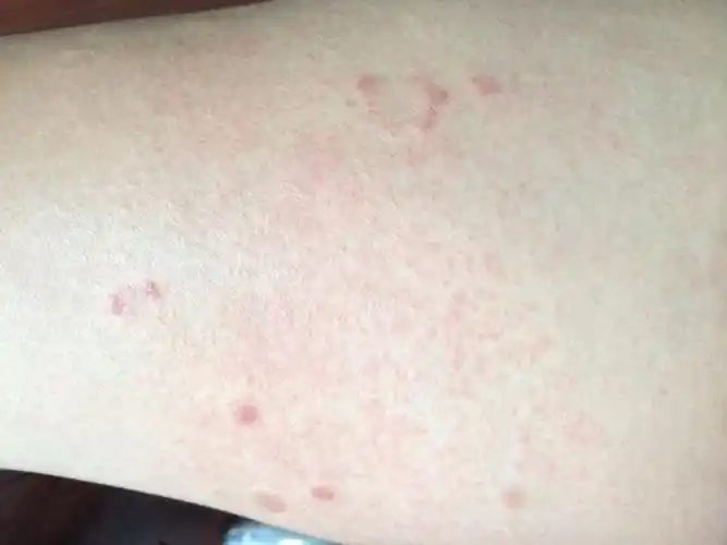 大腿内侧长仔仔,很痒,不知道是湿疹还是癣?