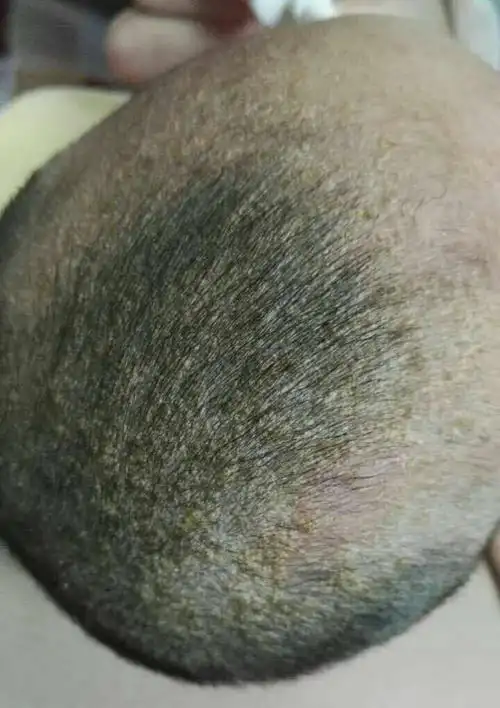 宝宝62天了女宝宝头上有黄色结痂好像是先流黄水在结痂