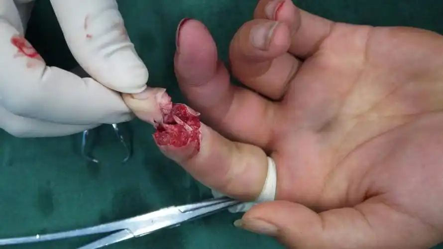 示指末节撕脱离断伤!