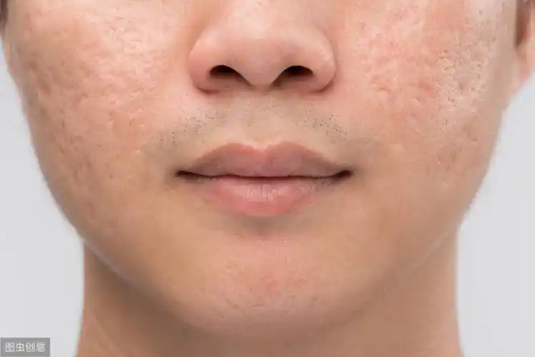 女人我最大毛孔女人毛孔粗大怎么办