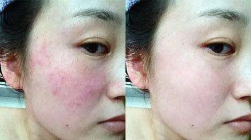 皮肤的好坏有时候能直接决定颜值的高低,所以很多女生都竭尽全力让