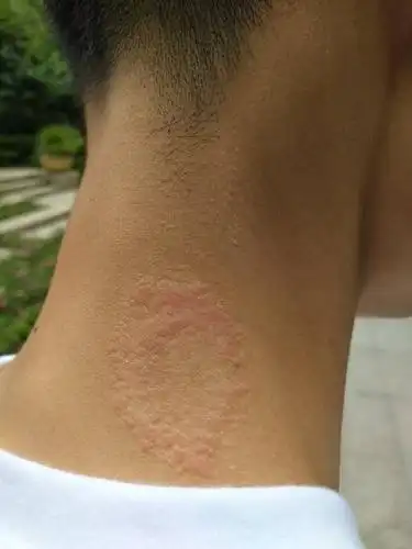 脖子后面有一小块红疙瘩是怎么回事呀?