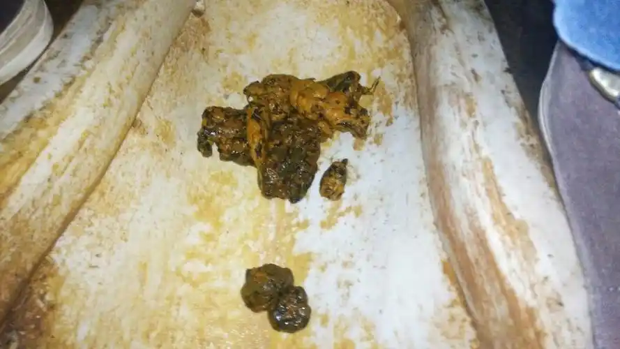 这种属消化不良还是大便出血