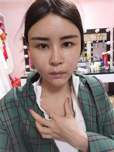 今天是在成都华美紫馨做全脸脂肪填充第十天了,脸上的_圈子-新氧美容