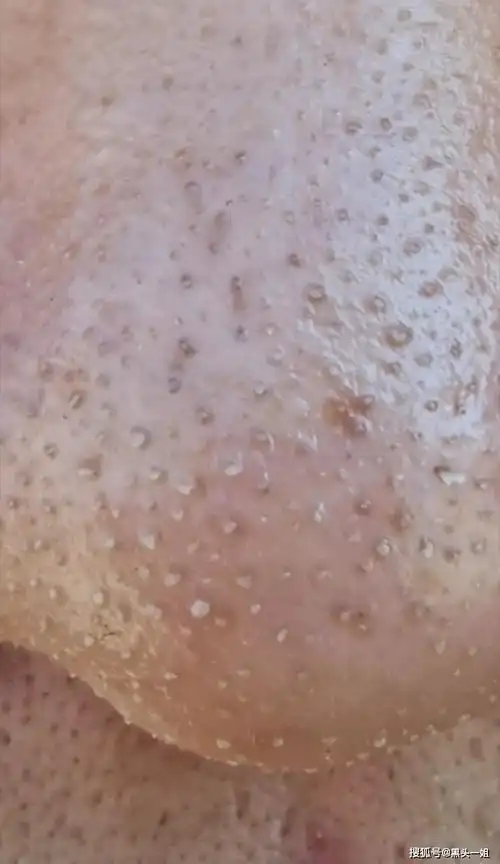 毛孔里明显的一颗一颗的油脂颗粒