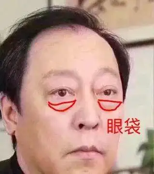 疲态满满95一旦成了熬成真性眼袋,像倪大红这种都无法拯救.