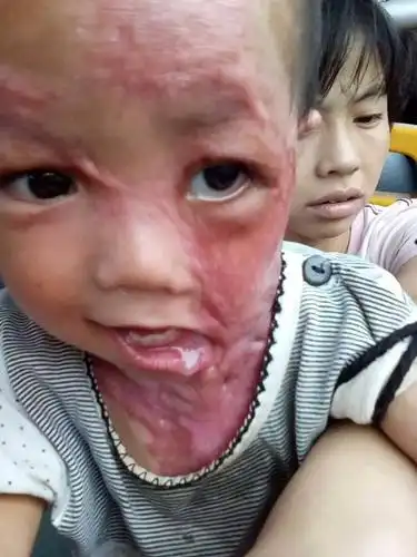 太揪心!乐平3岁幼童意外严重烫伤,家长心急求助!