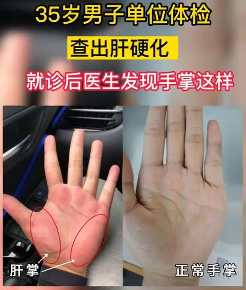 常见疾病 慢性乙型肝炎,肝硬化等.