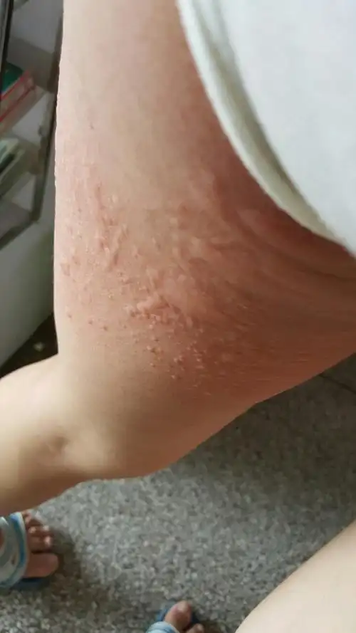 孕晚期身上老长这些包包又痒的,不过一会又没有了,昨回事了,请看图片