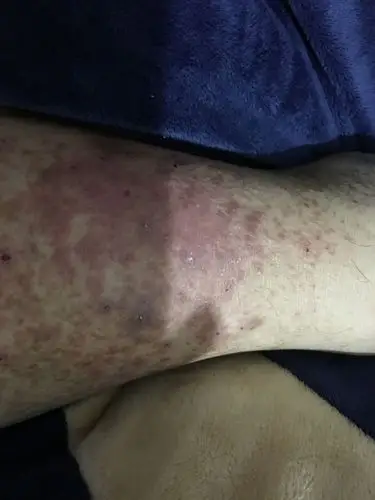 一开始腿上长了几个小包 有时痒 挠了破养了挠 一直都不好 去小医院