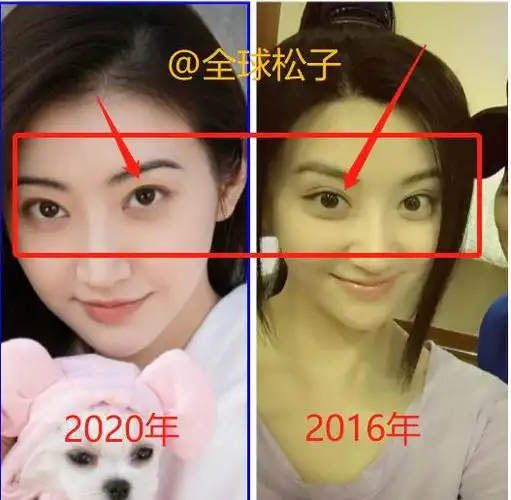 景甜曾因双眼皮太宽像"悲伤蛙",她在直播中首回应并承认整形