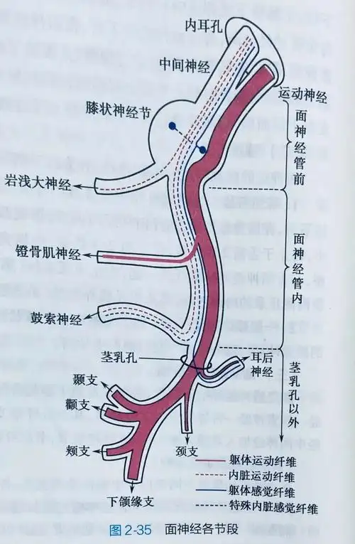 面瘫定位:周围性还是中枢性?颅内还是颅外病变?