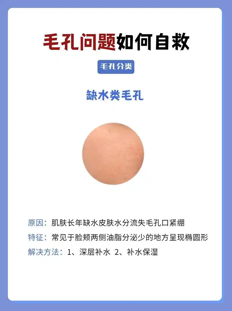 毛孔粗大如何自救71分清类型9499.