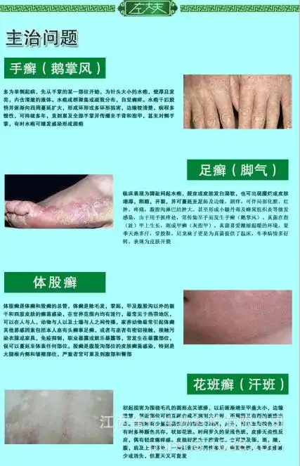 冰灵草草本乳膏15g 外用抑菌皮炎平清爽止痒润肤湿疹体癣股癣脚气脚癣