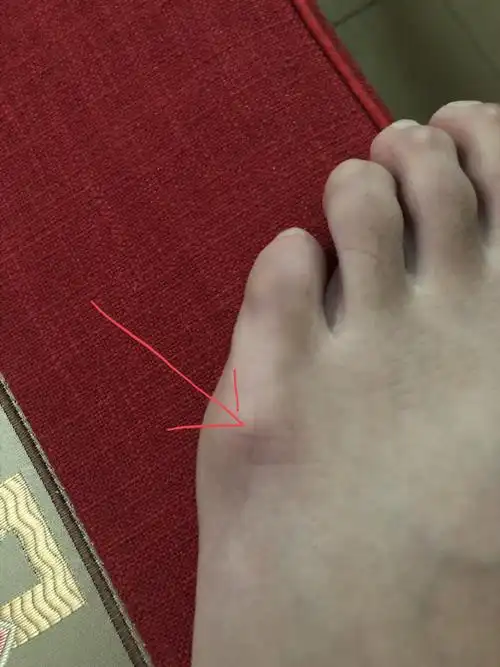 求问,左脚小拇指骨穿鞋痛 右脚正常 这是怎样回事?