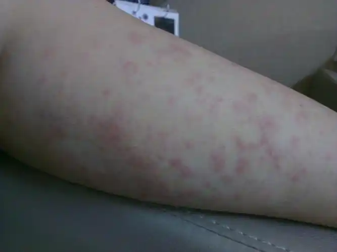 腿上长了一颗颗的,最后长成一个圈形,受热会痒,医生有说皮炎有说湿疹