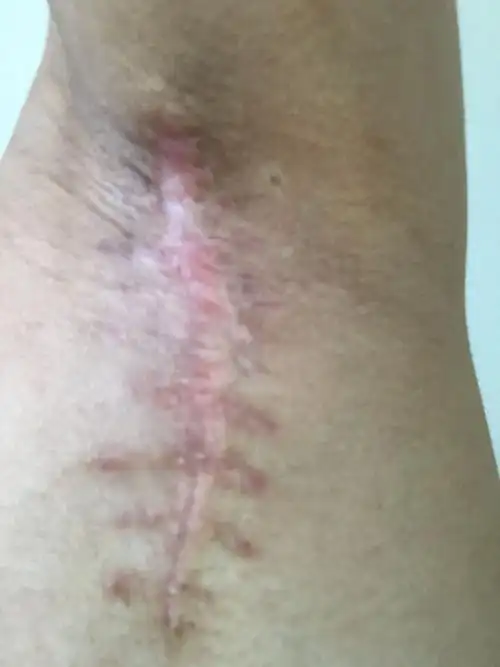 腋臭切除术的伤疤要多久才会不明显,伤口很大,很明显,这是两边腋下的