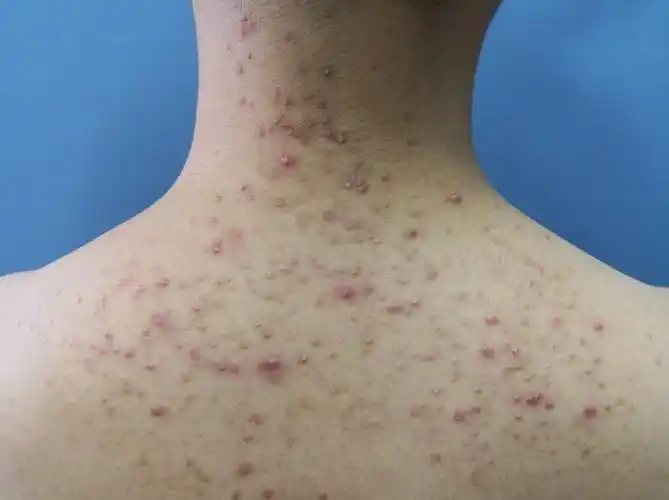 糠秕孢子菌毛囊炎,是近几年报道的一种皮肤病,由真菌感染引起.