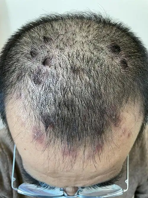 头皮有银屑病,有快速治疗的方法吗?