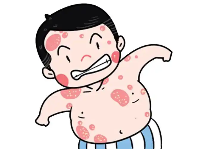 红皮型银屑病为什么会出现水肿现象?
