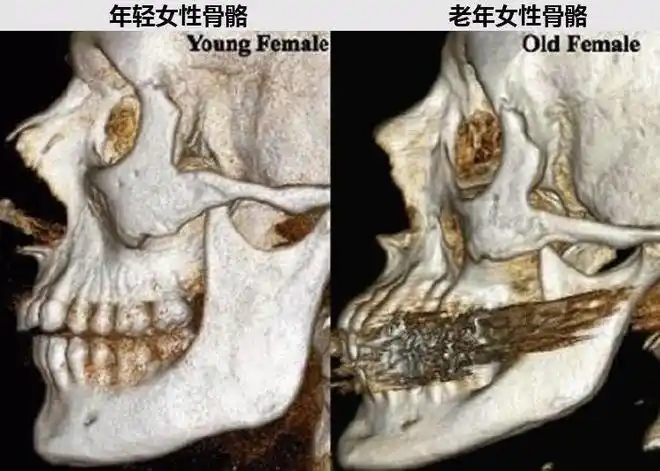 面部骨骼能给面部软组织和五官提供支撑力,在衰老过程中,骨骼会选择性