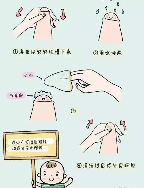 对于4-6岁仍包茎的儿童,70%-80%的包茎可以松解.