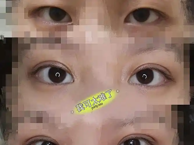 单眼皮,上睑提肌无力,我觉得现在双眼皮手术非常普遍_圈子-新氧美容