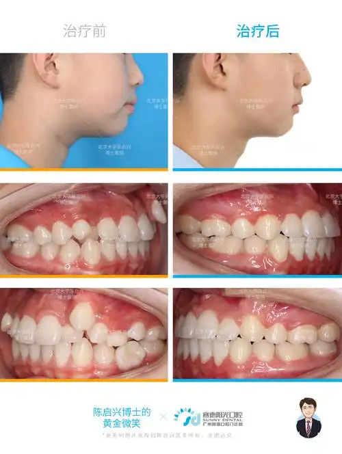 牙齿-侧面及口内对比.jpg