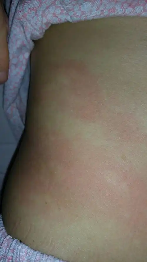 大家帮我看看这是皮肤病还是过敏,白天什么都没有一点也不痒,到了晚上