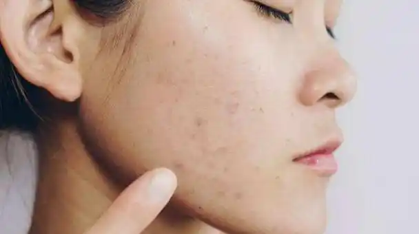 油性痘痘肌毛孔粗大用什么护肤品(油痘肌毛孔粗大用什么护肤品好(适合