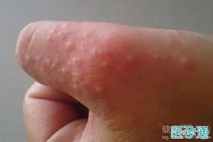 手部面部季节性湿疹图片春季高发如何预防