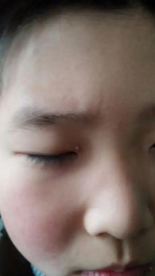 小孩子十一岁,眼角长个小疙瘩,七八个月了,医院问过老中医,医生说用