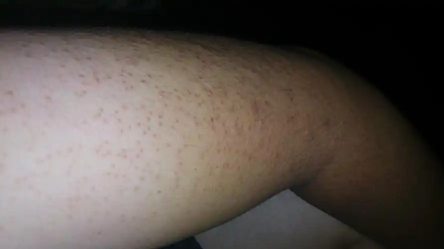 胳膊上皮肤粗糙好几年了我今年26岁不疼不痒遇冷风偶尔