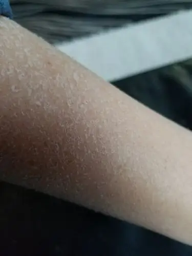 万能的山,有没有专家能告诉怎么缓解皮肤干燥蜕皮啊?