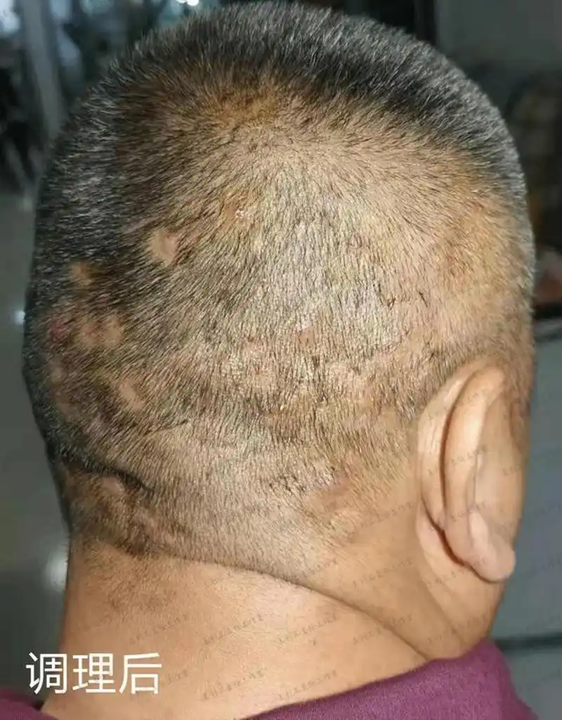 头皮出油多,毛囊炎反复,中医调理有妙招  我曾经遇到一位患者,得毛囊