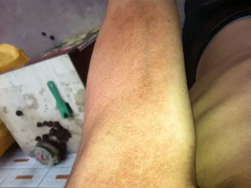 皮下脂肪萎缩,十六七年了,一开始范围很小,不痛不痒,看上去好象有色素