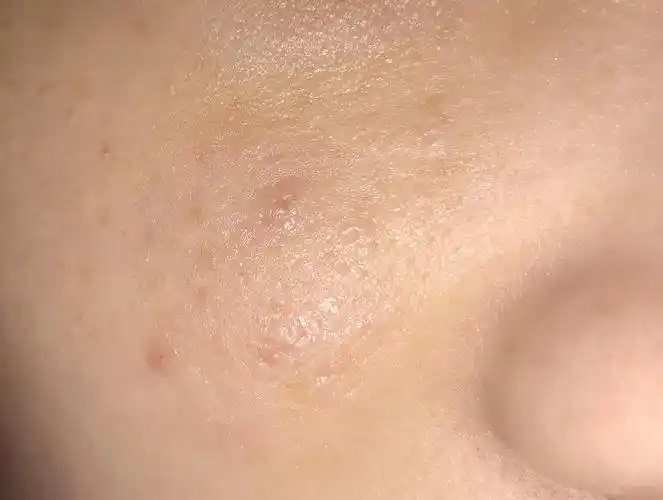 脸上的死皮怎么处理啊