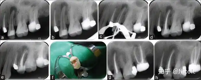 上颌第二前磨牙vi型根管配置