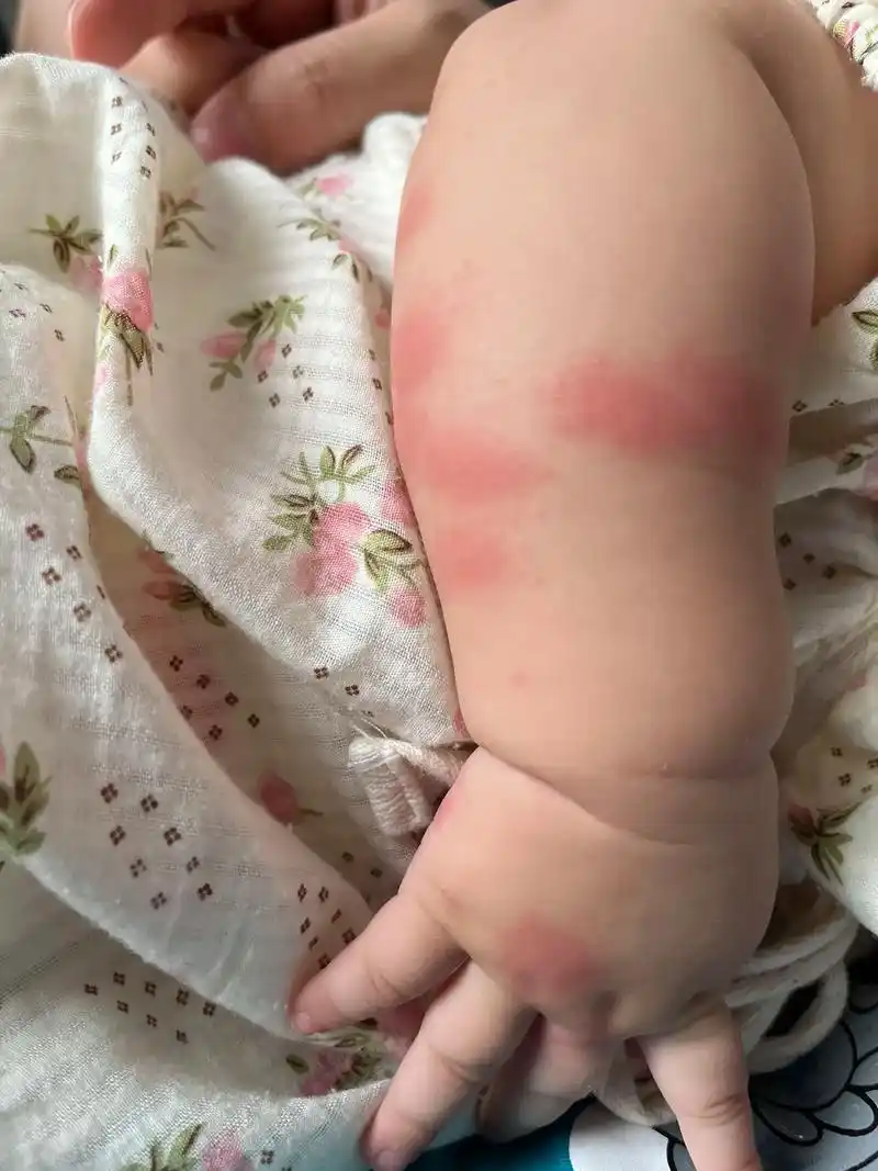 这挨千刀的蚊子,咬的我宝宝十几个包,心疼死为娘了#该死的蚊子 - 抖音